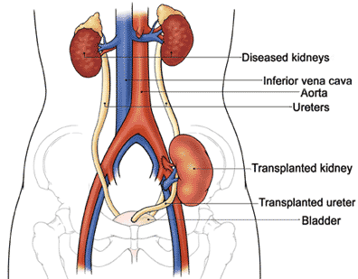 Kidney transplant procedure