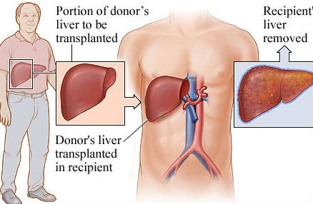 liver transplant procedure
